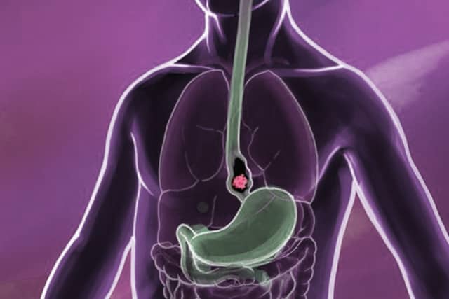 screening of Esophageal Cancer
