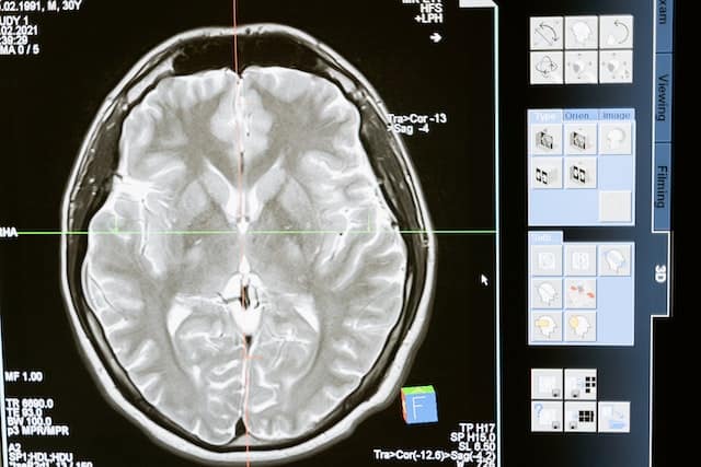 brain tumor overview- best brain tumor treatment in India